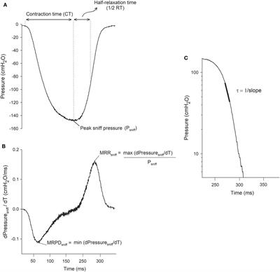 Multiparametric Analysis of Sniff Nasal Inspiratory Pressure Test in Middle Stage Amyotrophic Lateral Sclerosis